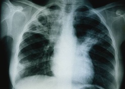 La région de Dakar concentre 45% des cas de tuberculose (responsable)  La région de Dakar concentre 45% des cas de tuberculose (responsable)