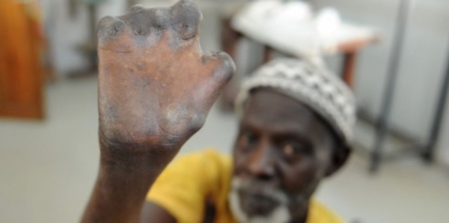 332 nouveaux cas de lèpre détectes au Sénégal en 2016