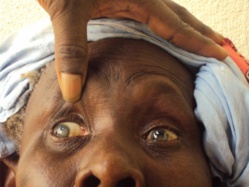 165 mille aveugles et 550 mille malvoyants au Sénégal