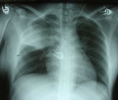 SANTE: Lancement d’un nouveau vaccin contre la pneumonie SANTE: Lancement d’un nouveau vaccin contre la pneumonie
