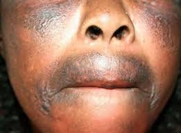 Ravages du Xessal : une dermatologue propose l’interdiction de la vente des produits cosmétiques dépigmentants Ravages du Xessal : une dermatologue propose l’interdiction de la vente des produits cosmétiques dépigmentants
