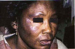 Le ‘’Xessal’’ ou la dépigmentation des femmes sénégalaises: Quels sont les dangers de cette pratique ? Le ‘’Xessal’’ ou la dépigmentation des femmes sénégalaises: Quels sont les dangers de cette pratique ?