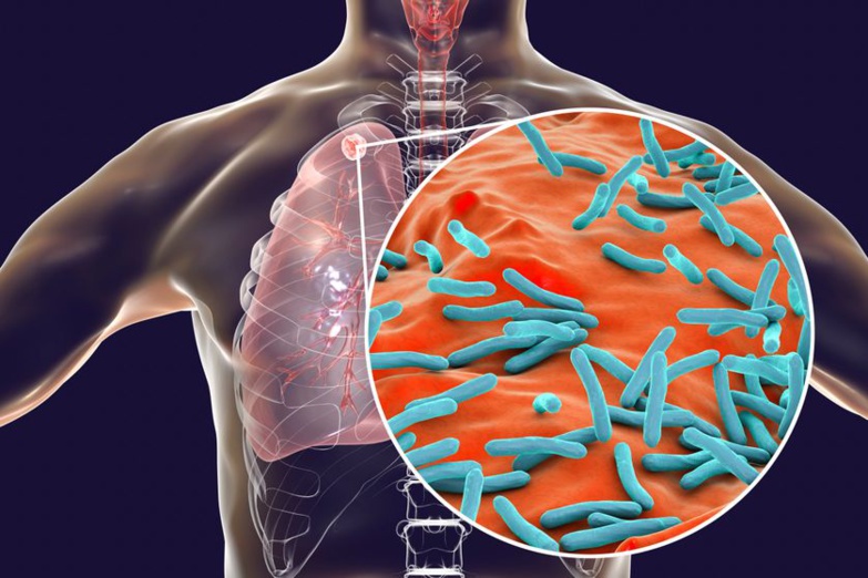 Tuberculose: Avec 420 morts en 2020, un tueur plus insidieux que la Covid-19, 2000 malades dans la nature