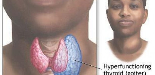 Plus de 70% des Sénégalais souffrent des maladies thyroïdiennes