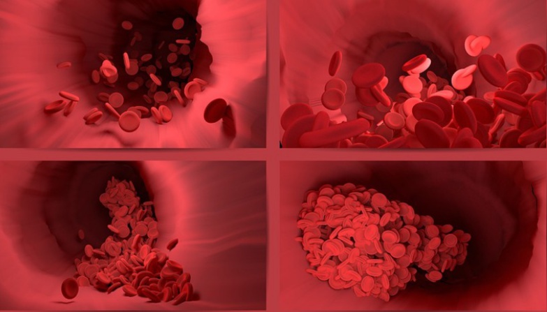 " La thrombose est la complication majeure de la Covid-19" " La thrombose est la complication majeure de la Covid-19"