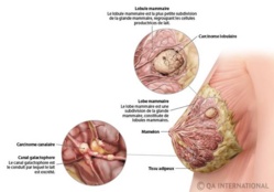 Saint-Louis : Consultations gratuites du cancer du sein, le 25 Octobre 2013