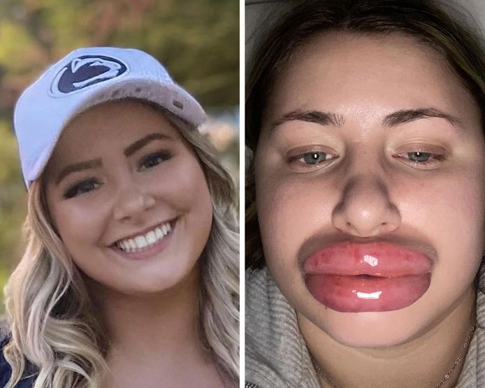 “Je ressemble à une poupée gonflable”: une TikTokeuse partage son opération des lèvres