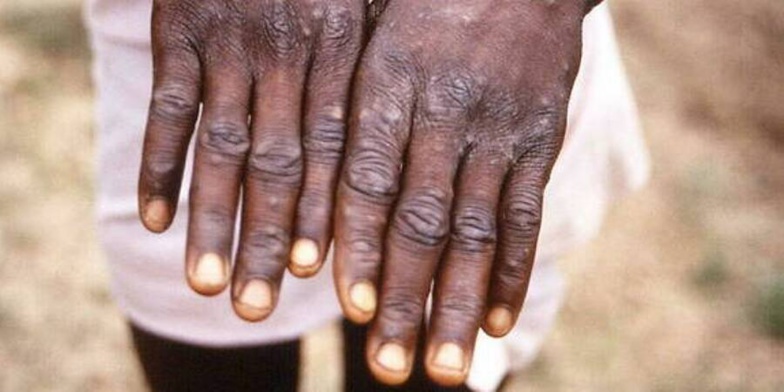 Variole du singe : Des cas confirmés détectés aux portes du Sénégal Variole du singe : Des cas confirmés détectés aux portes du Sénégal