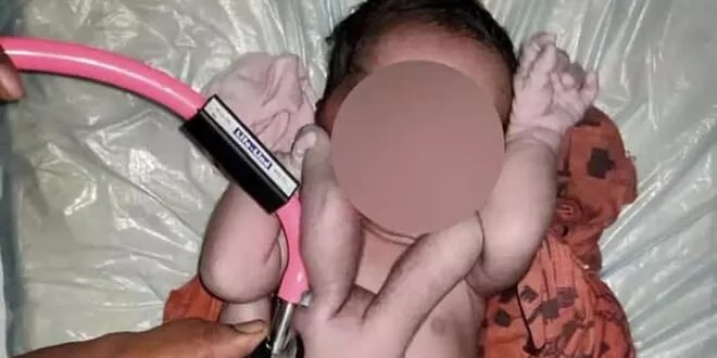 Inde: Un bébé « miracle » naît avec 4 bras et 4 jambes.