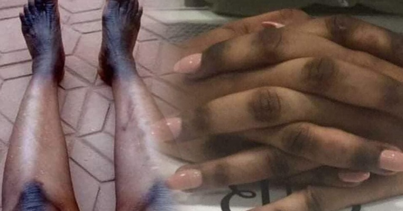 Dépigmentation par injection : les confessions froides des candidates Dépigmentation par injection : les confessions froides des candidates