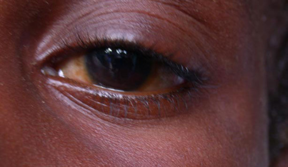 MALADIE CONTAGIEUSE: la conjonctivite ou «Apollo» fait fureur à Saint-Louis. MALADIE CONTAGIEUSE: la conjonctivite ou «Apollo» fait fureur à Saint-Louis.