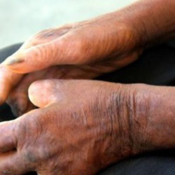 Santé – 200 nouveaux cas de lèpre diagnostiqués en 2015 au Sénégal