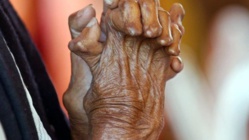 Alerte : la lèpre est de retour au Sénégal Alerte : la lèpre est de retour au Sénégal