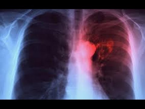 Tuberculose : Plus de 200 nouveaux cas détectés à Kaffrine