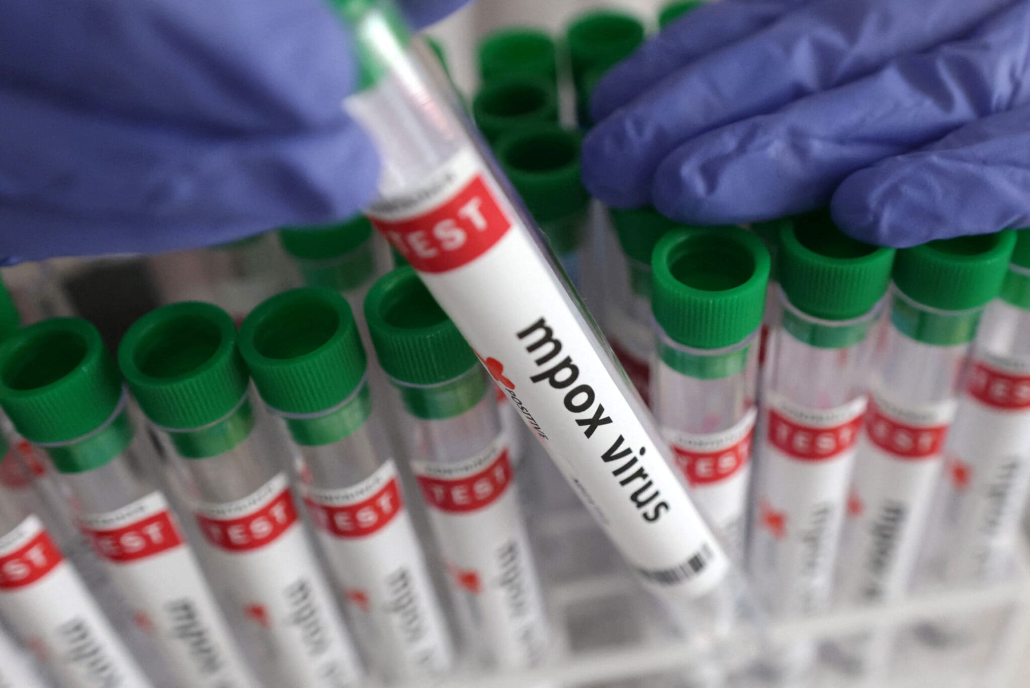 Dakar annonce un nouveau cas de Mpox après trois semaines sans infection active