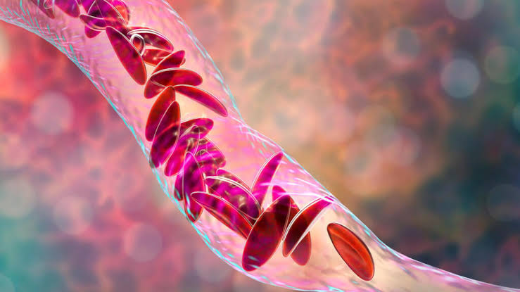 Sénégal : arrivée d’un médicament contre la drépanocytose début 2026