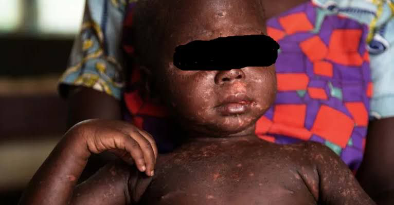 Kédougou : 22 cas positifs de rougeole diagnostiqués depuis début 2026