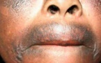 Dépigmentation : Le Sénégal classé 2e en Afrique derrière la République démocratique du Congo