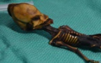 Le squelette d’Atacama faisant penser à un extraterrestre était celui d’une fillette