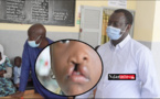 Santé infantile : de la chirurgie gratuite pour plus de 100 mômes de la Langue de Barbarie (vidéo)
