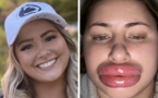 “Je ressemble à une poupée gonflable”: une TikTokeuse partage son opération des lèvres