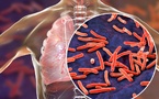 Tuberculose au Sénégal : 16 595 cas enregistrés en 2024