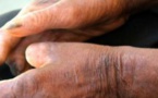 Santé – 200 nouveaux cas de lèpre diagnostiqués en 2015 au Sénégal