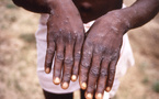 Un cas de Mpox détecté à Dakar
