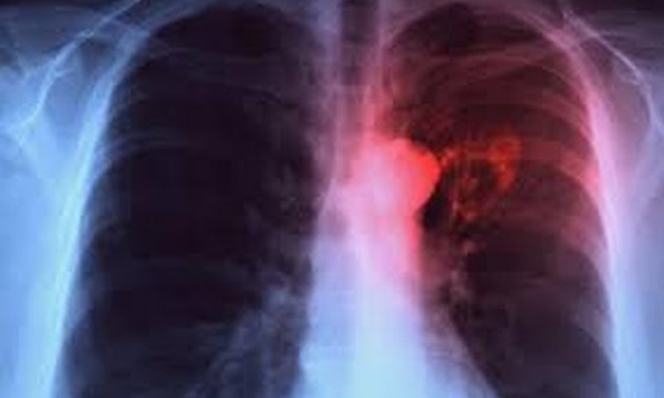 Tuberculose : Plus de 200 nouveaux cas détectés à Kaffrine