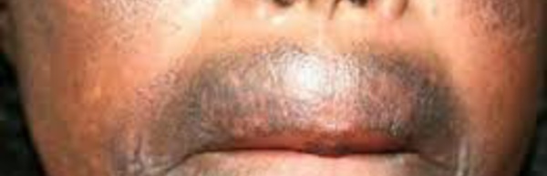 Ravages du Xessal : une dermatologue propose l’interdiction de la vente des produits cosmétiques dépigmentants