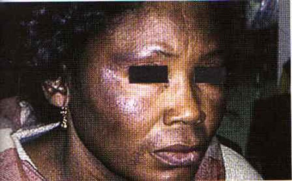 Le ‘’Xessal’’ ou la dépigmentation des femmes sénégalaises: Quels sont les dangers de cette pratique ?