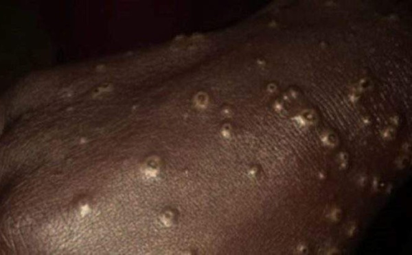 Une plante médicinale soigne la maladie mystérieuse de Thiaroye