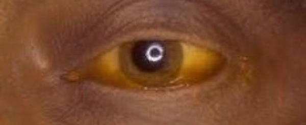 Huit cas de Fièvre jaune dont 02 décès au Sud du pays