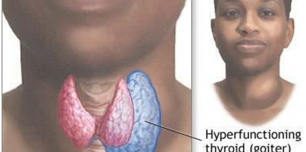 Plus de 70% des Sénégalais souffrent des maladies thyroïdiennes