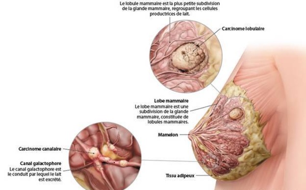 Saint-Louis : Consultations gratuites du cancer du sein, le 25 Octobre 2013