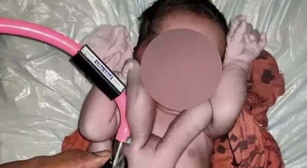 Inde: Un bébé « miracle » naît avec 4 bras et 4 jambes.