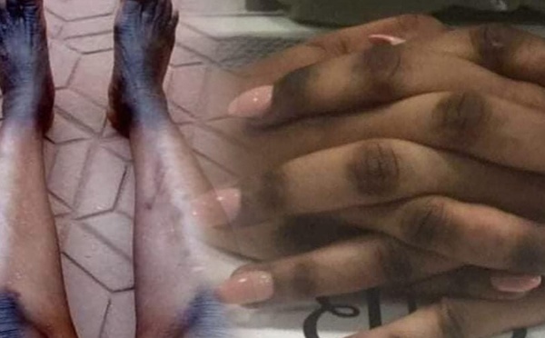 Dépigmentation par injection : les confessions froides des candidates