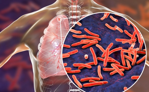 Tuberculose au Sénégal : 16 595 cas enregistrés en 2024