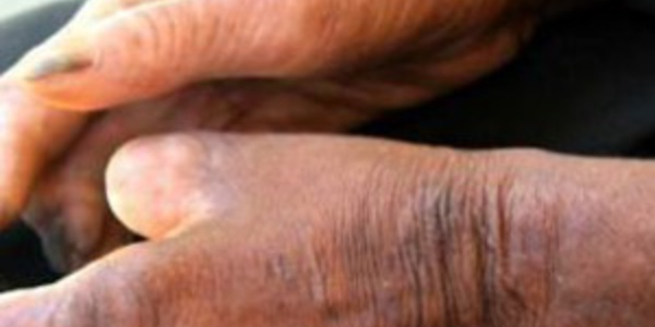 Santé – 200 nouveaux cas de lèpre diagnostiqués en 2015 au Sénégal