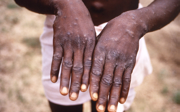 Un cas de Mpox détecté à Dakar