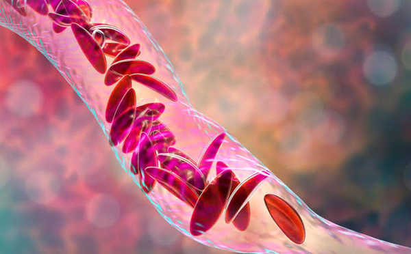 Sénégal : arrivée d’un médicament contre la drépanocytose début 2026