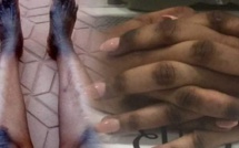 Dépigmentation par injection : les confessions froides des candidates