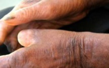 Santé – 200 nouveaux cas de lèpre diagnostiqués en 2015 au Sénégal