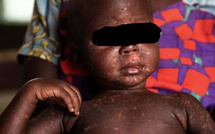 Kédougou : 22 cas positifs de rougeole diagnostiqués depuis début 2026