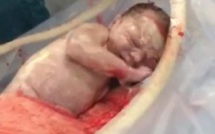 La césarienne la plus douce du monde: un bébé s'extrait seul du ventre de sa mère